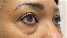 Eyelid Surgery Before Photo by Camille Cash, MD; Houston, TX - Case 47365