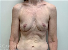 Breast Implant Removal After Photo by Camille Cash, MD; Houston, TX - Case 47371