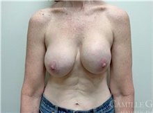 Breast Implant Removal Before Photo by Camille Cash, MD; Houston, TX - Case 47371