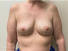 Breast Implant Removal After Photo by Camille Cash, MD; Houston, TX - Case 47372