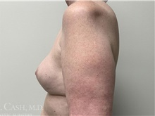 Breast Implant Removal After Photo by Camille Cash, MD; Houston, TX - Case 47372