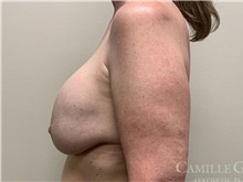 Breast Implant Removal Before Photo by Camille Cash, MD; Houston, TX - Case 47372