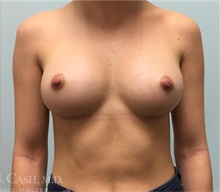 Breast Augmentation After Photo by Camille Cash, MD; Houston, TX - Case 47414