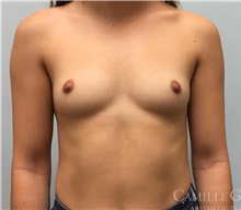 Breast Augmentation Before Photo by Camille Cash, MD; Houston, TX - Case 47414