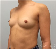Breast Augmentation Before Photo by Camille Cash, MD; Houston, TX - Case 47414