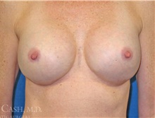 Breast Implant Revision After Photo by Camille Cash, MD; Houston, TX - Case 47415