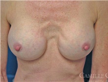 Breast Implant Revision Before Photo by Camille Cash, MD; Houston, TX - Case 47415