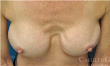 Breast Implant Revision Before Photo by Camille Cash, MD; Houston, TX - Case 47415