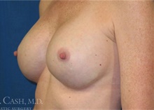 Breast Implant Revision After Photo by Camille Cash, MD; Houston, TX - Case 47415