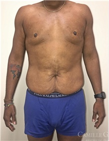 Tummy Tuck Before Photo by Camille Cash, MD; Houston, TX - Case 47427