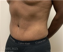 Tummy Tuck After Photo by Camille Cash, MD; Houston, TX - Case 47427