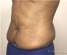 Tummy Tuck Before Photo by Camille Cash, MD; Houston, TX - Case 47427