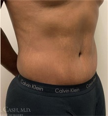 Tummy Tuck After Photo by Camille Cash, MD; Houston, TX - Case 47427