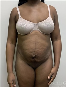 Tummy Tuck Before Photo by Camille Cash, MD; Houston, TX - Case 47504