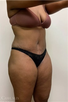 Tummy Tuck After Photo by Camille Cash, MD; Houston, TX - Case 47504