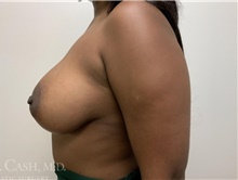 Breast Augmentation After Photo by Camille Cash, MD; Houston, TX - Case 47515