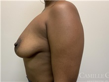 Breast Augmentation Before Photo by Camille Cash, MD; Houston, TX - Case 47515