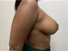 Breast Augmentation After Photo by Camille Cash, MD; Houston, TX - Case 47515