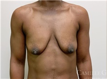 Breast Augmentation Before Photo by Camille Cash, MD; Houston, TX - Case 47520