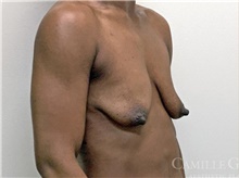 Breast Augmentation Before Photo by Camille Cash, MD; Houston, TX - Case 47520