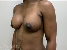 Breast Augmentation After Photo by Camille Cash, MD; Houston, TX - Case 47520