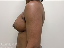 Breast Augmentation After Photo by Camille Cash, MD; Houston, TX - Case 47520