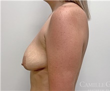Breast Lift Before Photo by Camille Cash, MD; Houston, TX - Case 47521