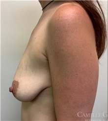 Breast Lift Before Photo by Camille Cash, MD; Houston, TX - Case 47522