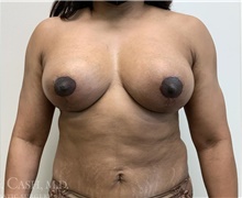 Breast Lift After Photo by Camille Cash, MD; Houston, TX - Case 47523