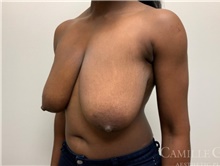 Breast Reduction Before Photo by Camille Cash, MD; Houston, TX - Case 47524