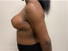 Breast Reduction After Photo by Camille Cash, MD; Houston, TX - Case 47524