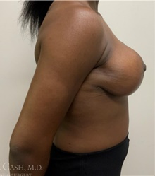 Breast Reduction After Photo by Camille Cash, MD; Houston, TX - Case 47524