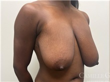 Breast Reduction Before Photo by Camille Cash, MD; Houston, TX - Case 47524