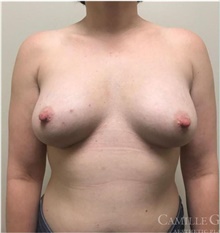Breast Implant Removal Before Photo by Camille Cash, MD; Houston, TX - Case 47525