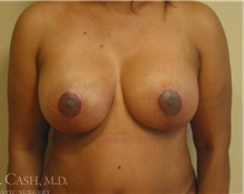 Breast Implant Revision After Photo by Camille Cash, MD; Houston, TX - Case 47526