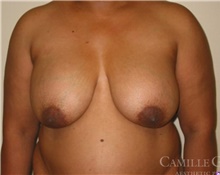 Breast Implant Revision Before Photo by Camille Cash, MD; Houston, TX - Case 47526