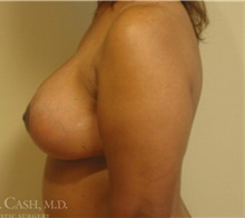 Breast Implant Revision After Photo by Camille Cash, MD; Houston, TX - Case 47526