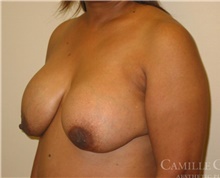 Breast Implant Revision Before Photo by Camille Cash, MD; Houston, TX - Case 47526