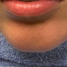 Dermal Fillers After Photo by Camille Cash, MD; Houston, TX - Case 47527