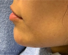 Dermal Fillers After Photo by Camille Cash, MD; Houston, TX - Case 47527