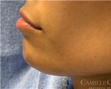 Dermal Fillers Before Photo by Camille Cash, MD; Houston, TX - Case 47527