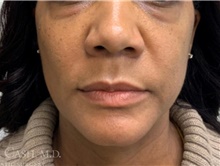 Dermal Fillers After Photo by Camille Cash, MD; Houston, TX - Case 47528