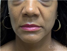 Dermal Fillers Before Photo by Camille Cash, MD; Houston, TX - Case 47528