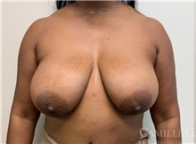 Breast Reduction Before Photo by Camille Cash, MD; Houston, TX - Case 47529
