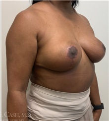 Breast Reduction After Photo by Camille Cash, MD; Houston, TX - Case 47529