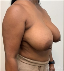 Breast Reduction Before Photo by Camille Cash, MD; Houston, TX - Case 47529