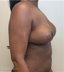 Breast Reduction After Photo by Camille Cash, MD; Houston, TX - Case 47530