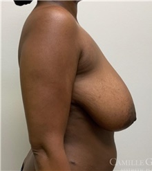 Breast Reduction Before Photo by Camille Cash, MD; Houston, TX - Case 47530