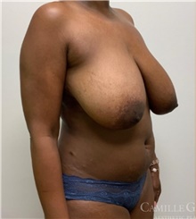 Breast Reduction Before Photo by Camille Cash, MD; Houston, TX - Case 47530