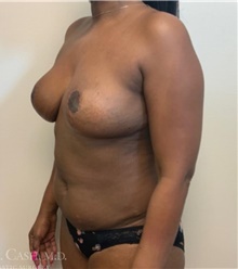 Breast Reduction After Photo by Camille Cash, MD; Houston, TX - Case 47530